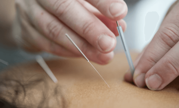 Acupuncture Services for Natural Healing and Wellness