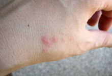 Why Some People Don’t React to Bed Bug Bites