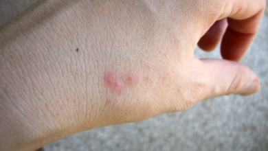 Why Some People Don’t React to Bed Bug Bites