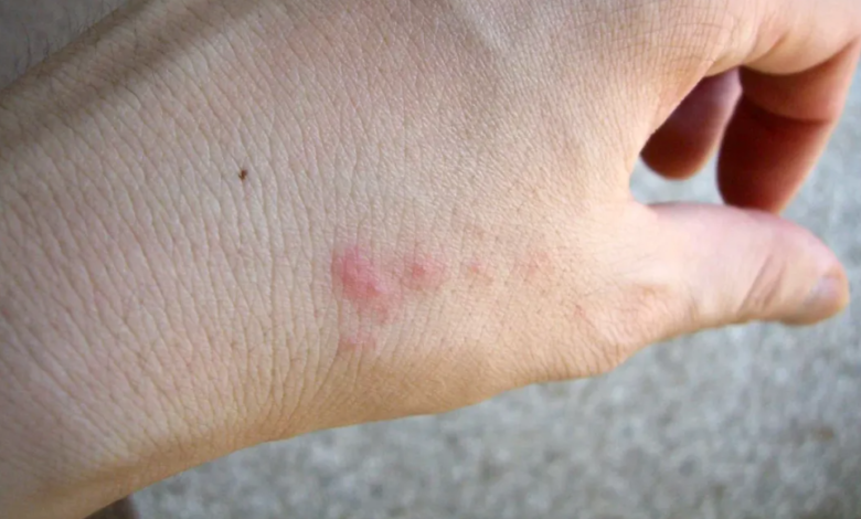 Why Some People Don’t React to Bed Bug Bites